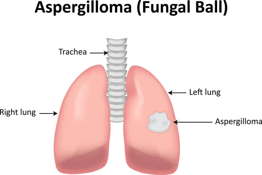 aspergilloma